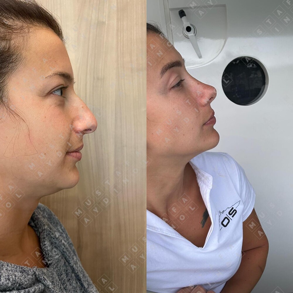 Before and After Result